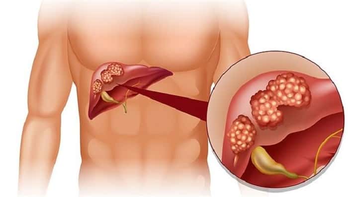 Ung thư gan là giai đoạn cuối của viêm gan, xơ gan hay gan nhiễm mỡ